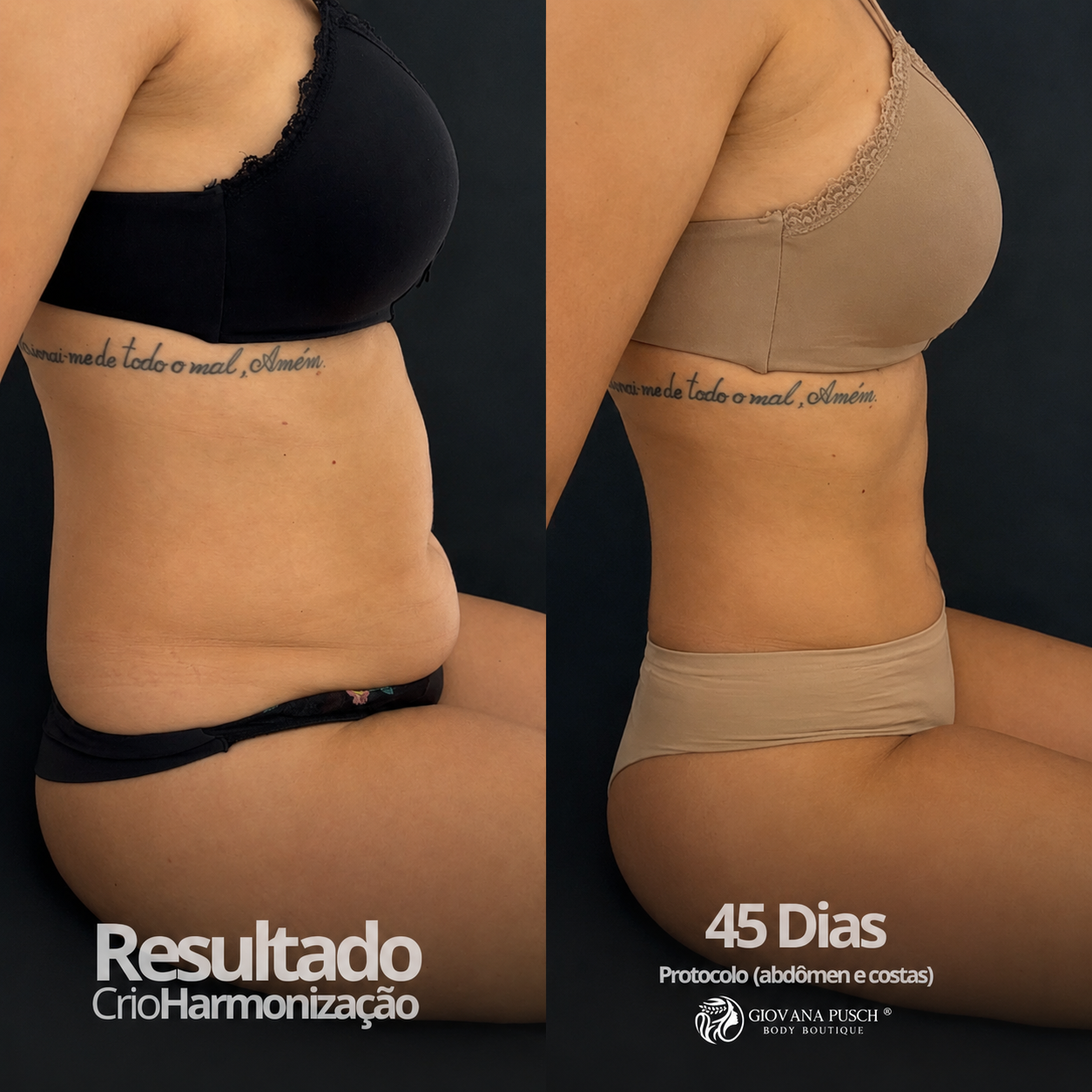 Antes e depois Abdômen · 45 dias