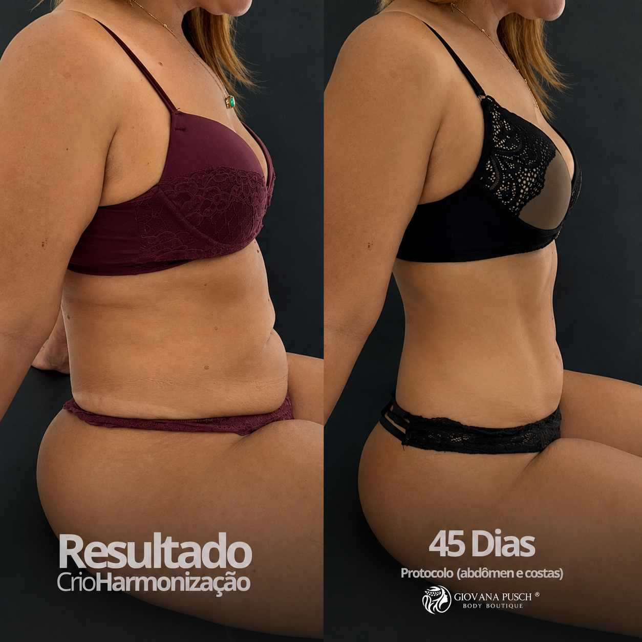 Antes e depois Abdômen · 45 dias