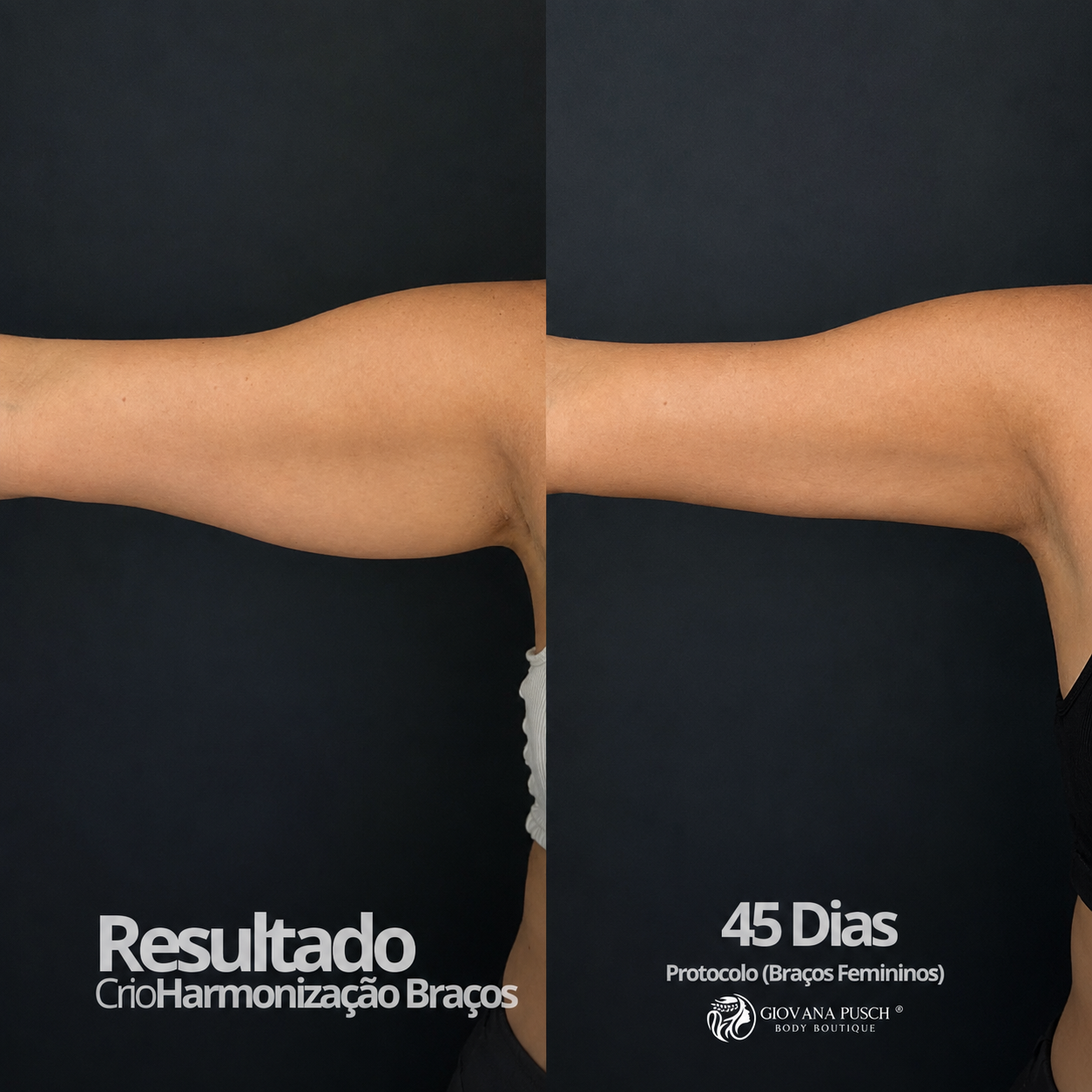 Resultado Braços femininos · 45 dias