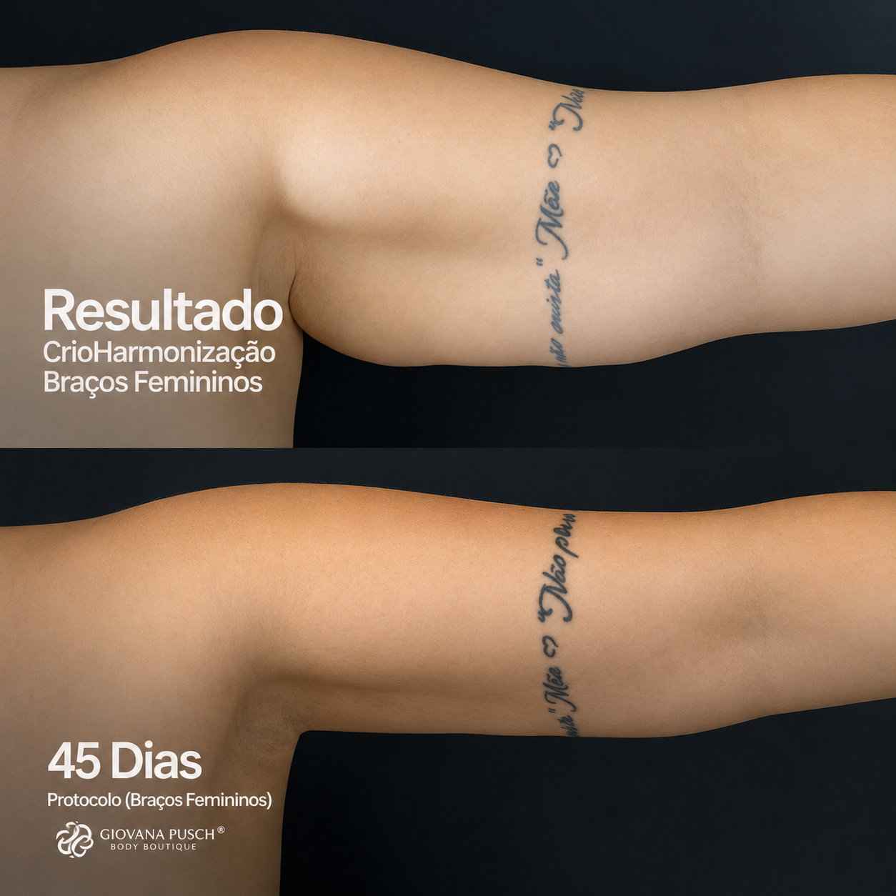 Resultado Braços femininos · 45 dias